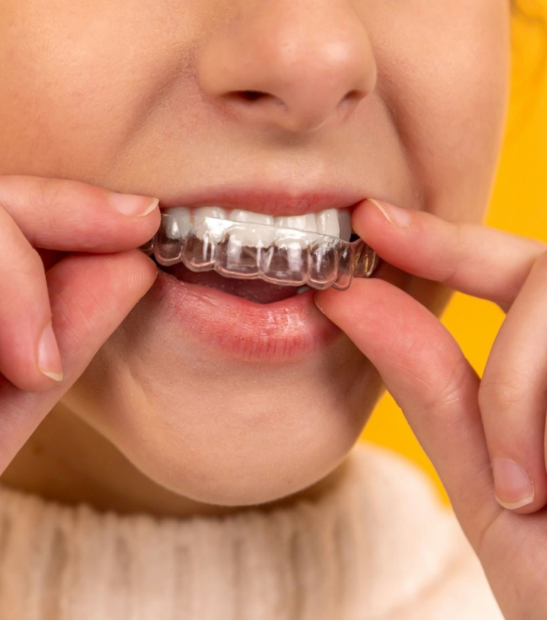 Person inserting a clear aligner, comparing clear aligners vs braces