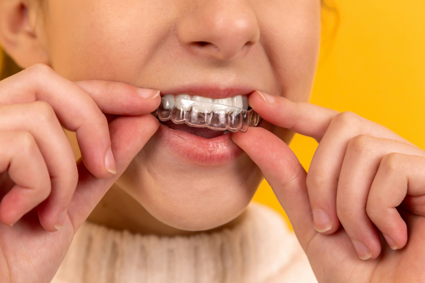 Person inserting a clear aligner, comparing clear aligners vs braces