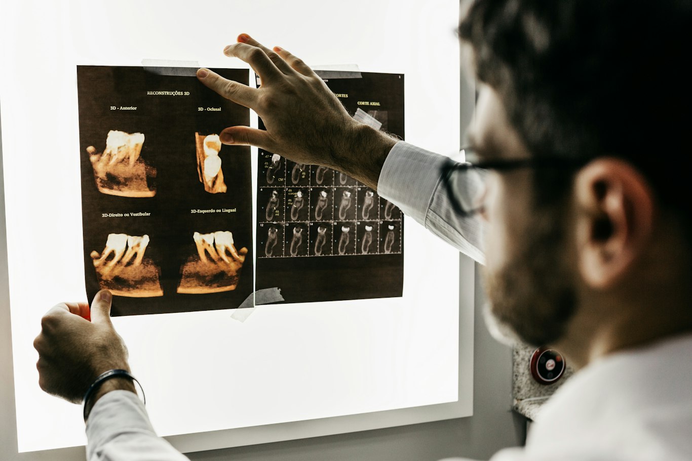 Dentist reviewing dental x-rays of wisdom teeth