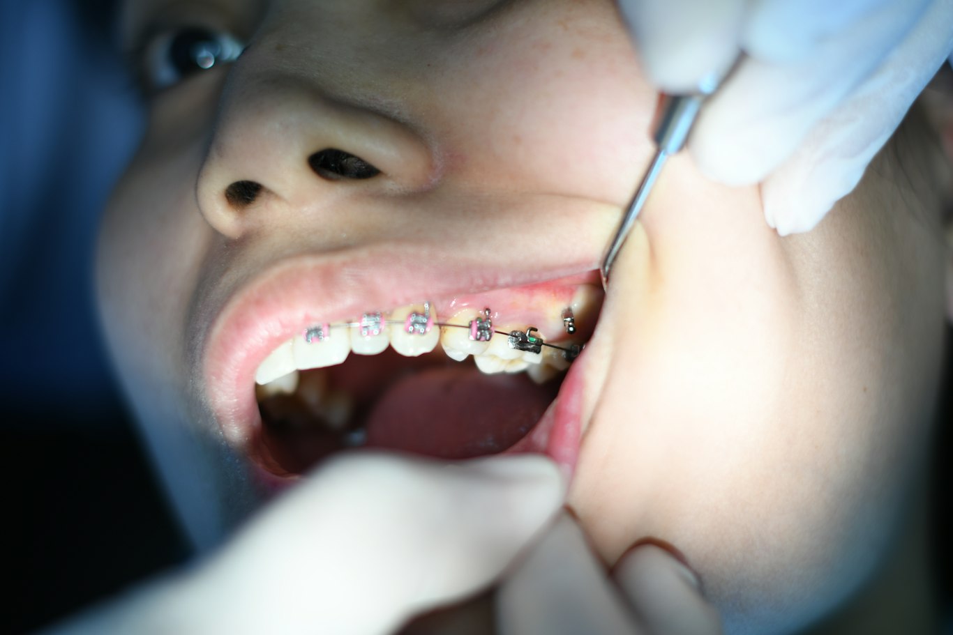 Close-up of metal braces on teeth