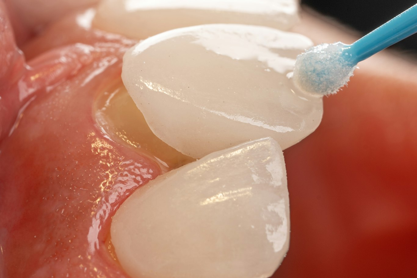 Close-up of cleaning between teeth, water flosser vs floss comparison