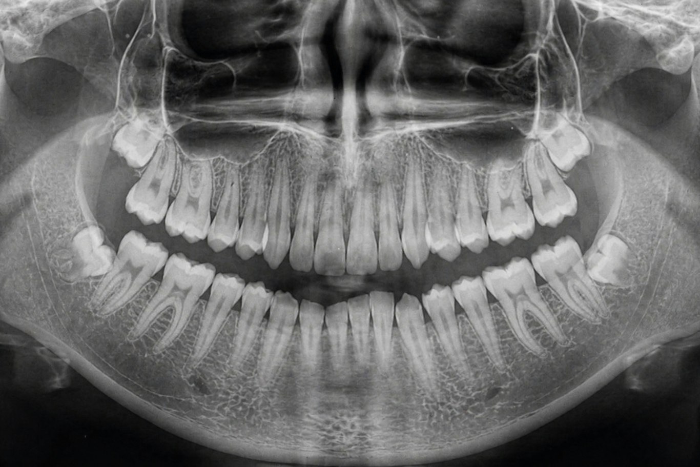 Panoramic dental x-ray used to plan wisdom teeth removal